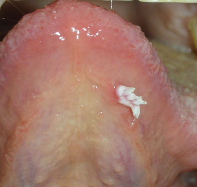 papilloma a cellule squamose lingua