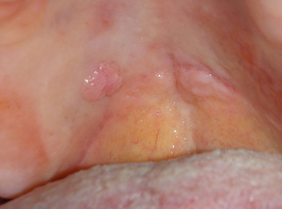 papilloma virus palato sintomi